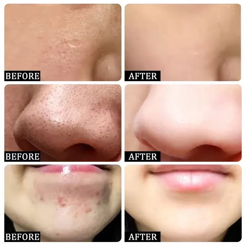 Salicylic Acid Pore Shrinking Cream