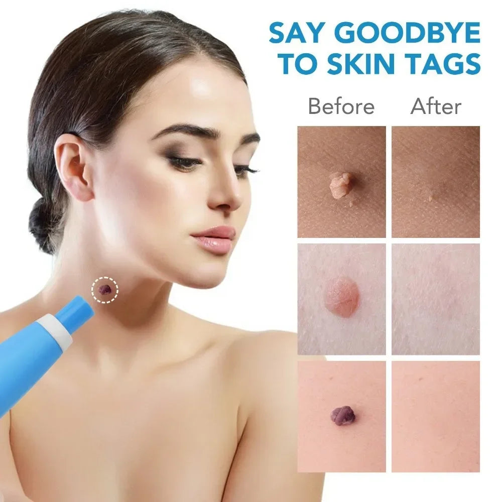 Painless Skin Tag Removal Kit