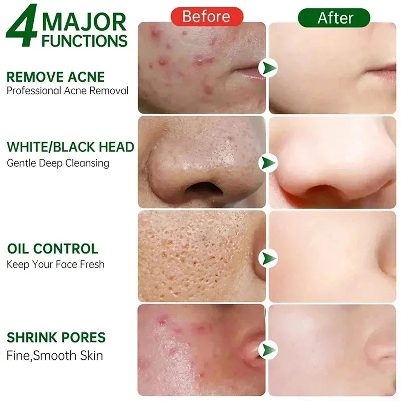 Pore Shrinking Cream Elimination Large Pores Blackehead Remove Acne Pit Repair Gel Tighten Face Smooth Skin Korean Care Products - PrimeNest
